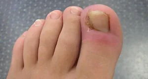 denise-polizel-unhas-encravadas